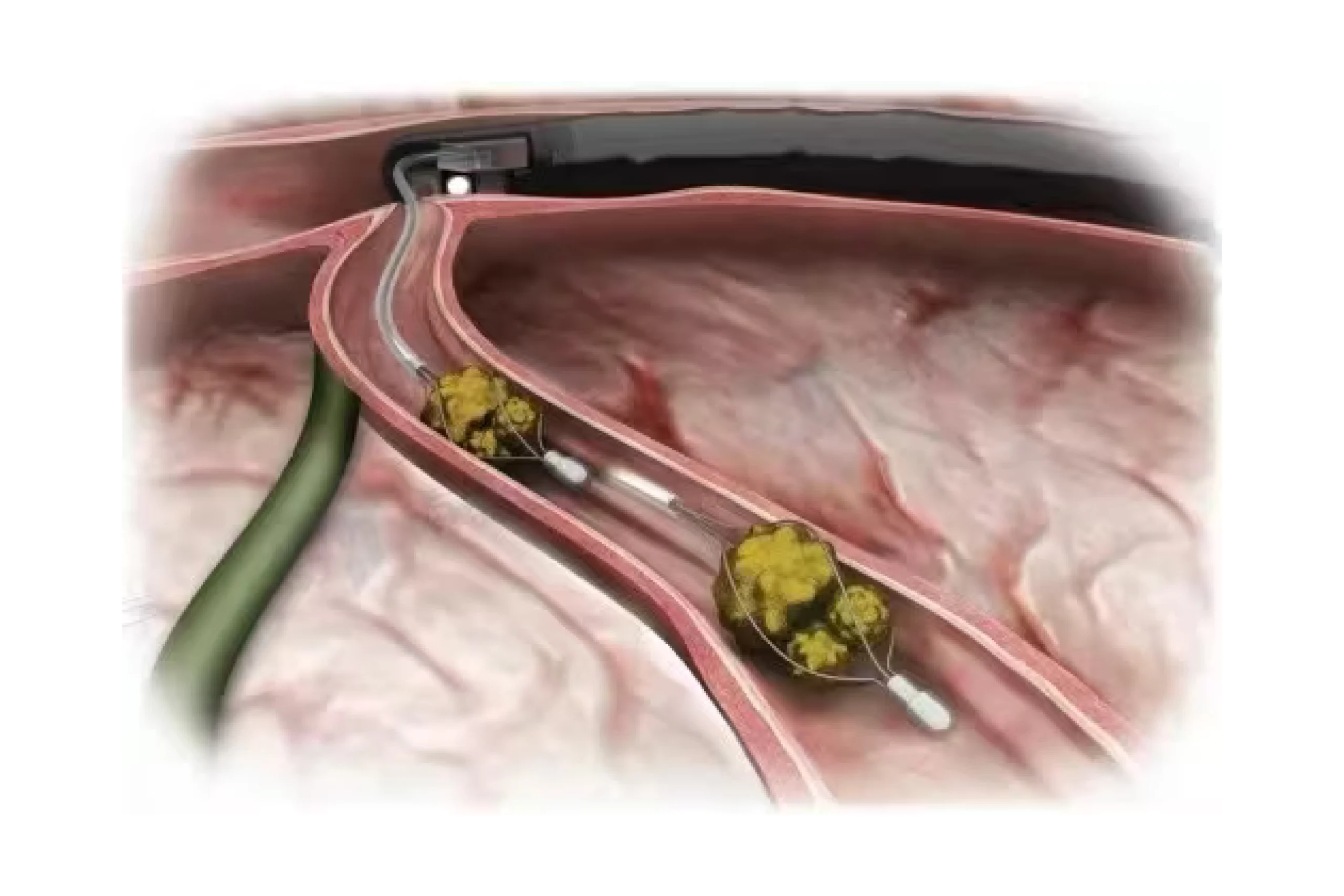 Stone Extraction Basket (BB:Oval/BC:Spiral Type)-Gastro